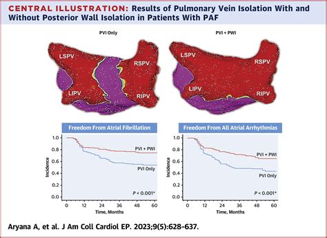 Posterior Wall Isolation for Atrial Fibrillation: Time to 